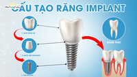 TOP 5+ Địa Chỉ Trồng Răng Implant Uy Tín Nha Trang