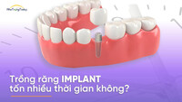 TOP 4+ Địa Chỉ Trồng Răng Implant Uy Tín Nha Trang