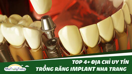 TOP 4+ Địa Chỉ Trồng Răng Implant Giá Rẻ - Uy Tín Nha Trang
