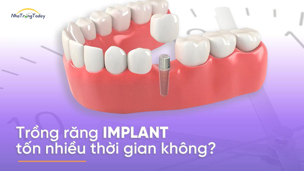 địa chỉ trồng răng Implant nha trang