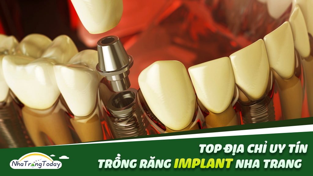 TOP 5+ Địa Chỉ Trồng Răng Implant Giá Rẻ - Uy Tín Nha Trang